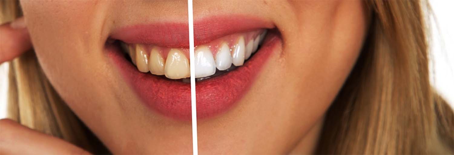 dents blanches